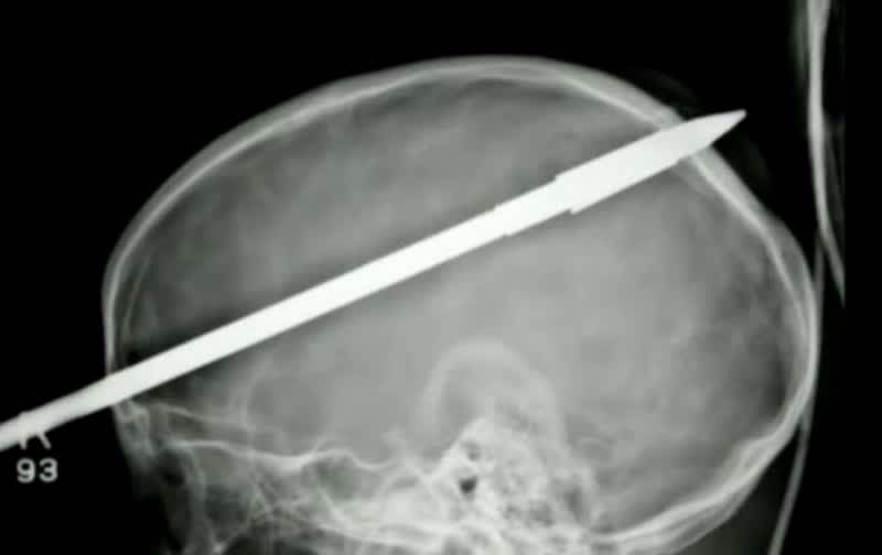 16 Year Old Boy Survives Being Shot through the Head with a Spear