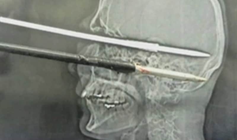 Brazilian Angler Survives 12-inch Spear to the Face