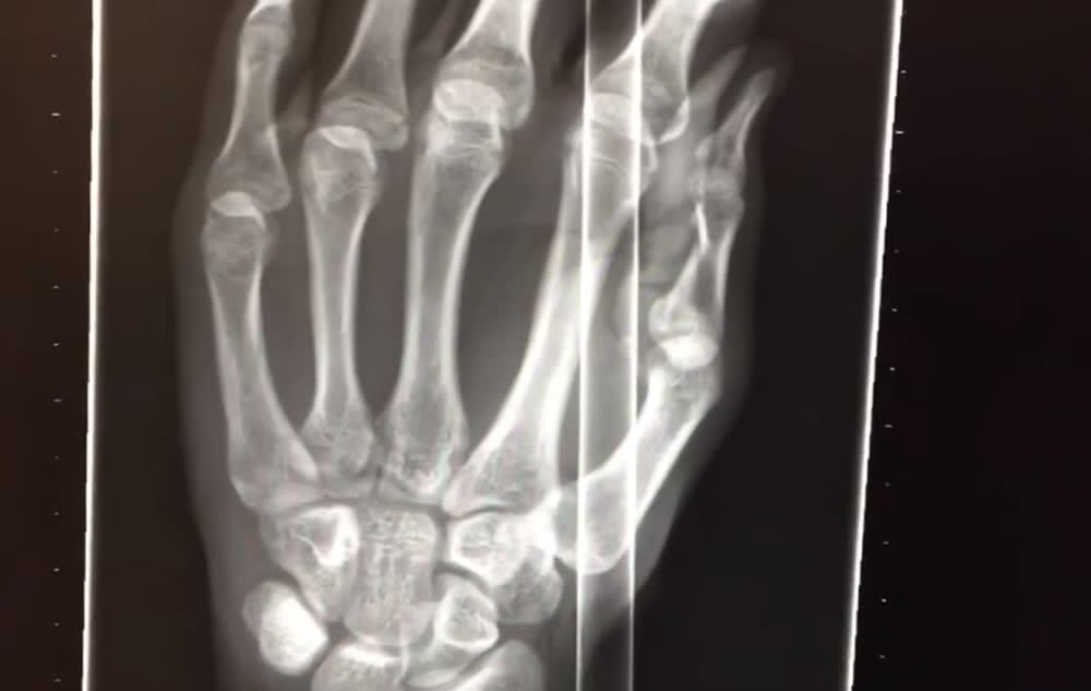 Doctor Demonstrates How to Remove Arrow from Patient’s Hand (Graphic)