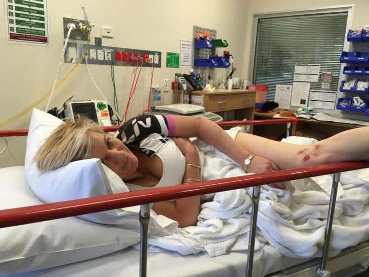 Australian Woman Loses Breast Implants after Being Kicked by a Kangaroo