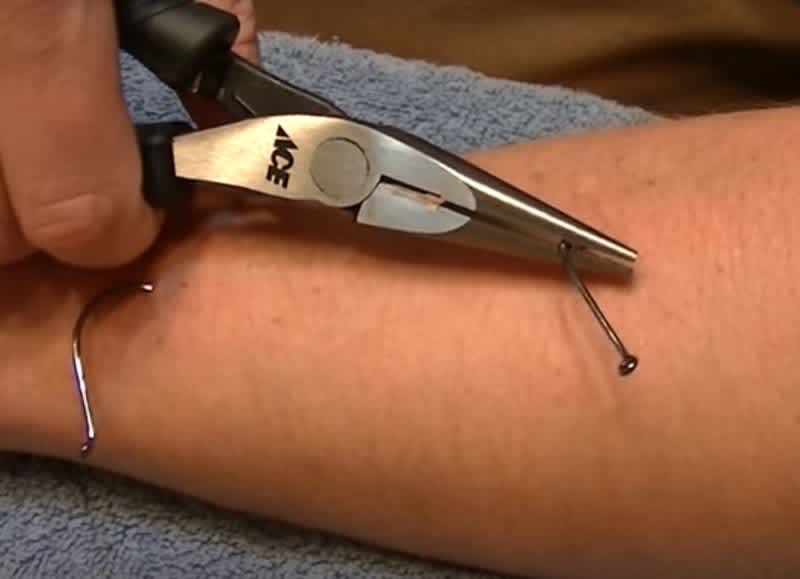 Graphic Video: How To Remove Fish Hooks From Your Skin