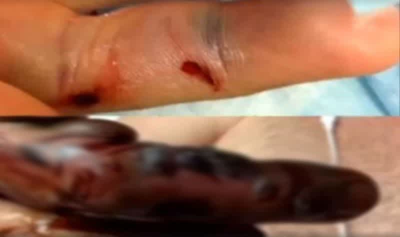 Video: Oklahoma Man Bitten by Snake While Noodling (Warning: Graphic  Images)
