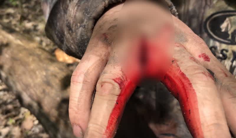 Graphic Video: Turkey Spur Gashes Hunter’s Hand