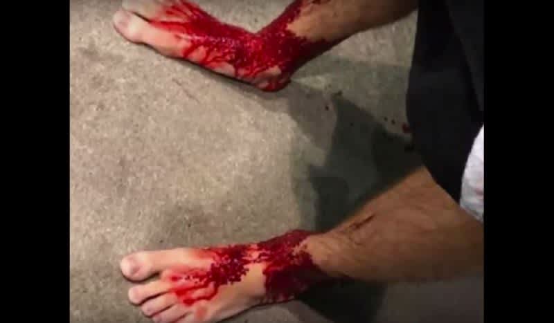 Video: Mysterious Flesh-Eating Marine Creatures Chew Teenager’s Legs