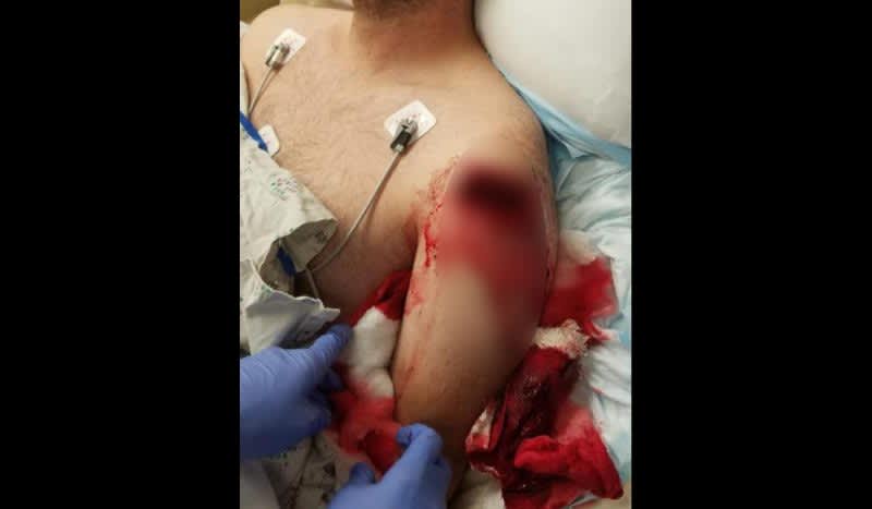 Graphic: Elk Hunter Shot by Another Archer Who Failed to Confirm His Target