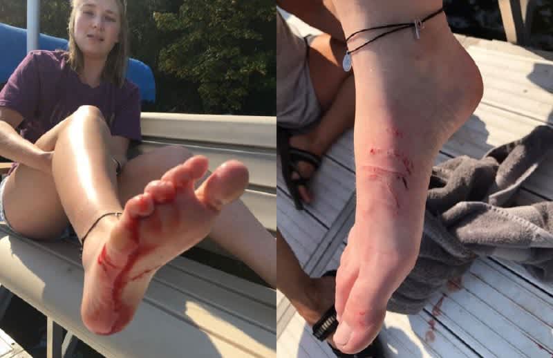 Another Strange Muskie Attack on a Minnesota Lake Leaves Young Girl Shaken and Bloody