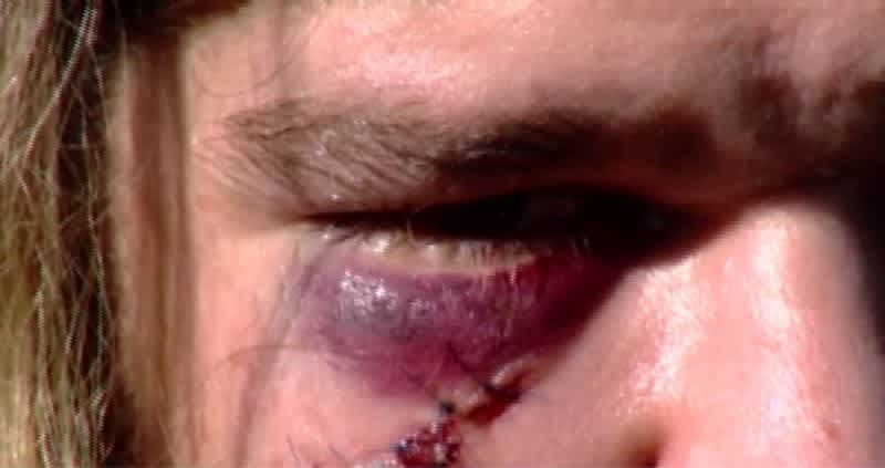 Video: New York Man Left Bloody and Bruised After Being Attacked by Rabid 10-Point Buck