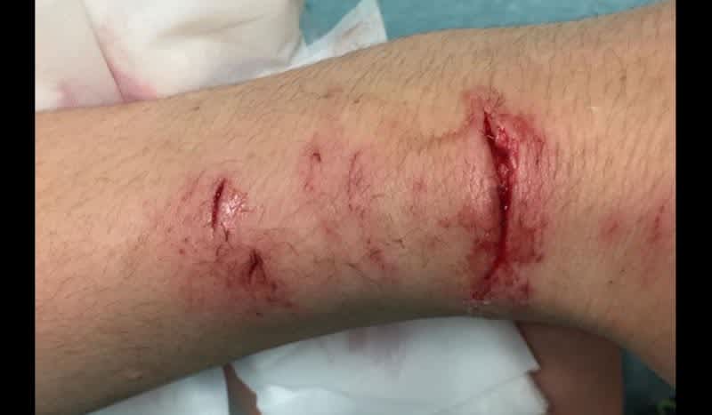 New York Mom Posts Photos on Facebook After Muskie Bites Her Son’s Arm