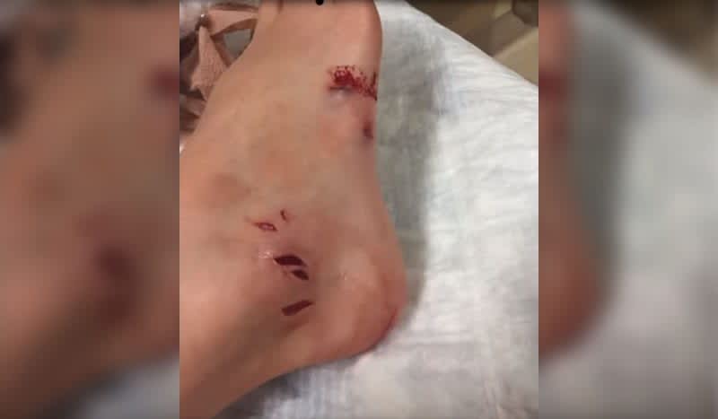 Fish Bite on Wisconsin Lake Sends Boy to Hospital, Receives 16 Stitches
