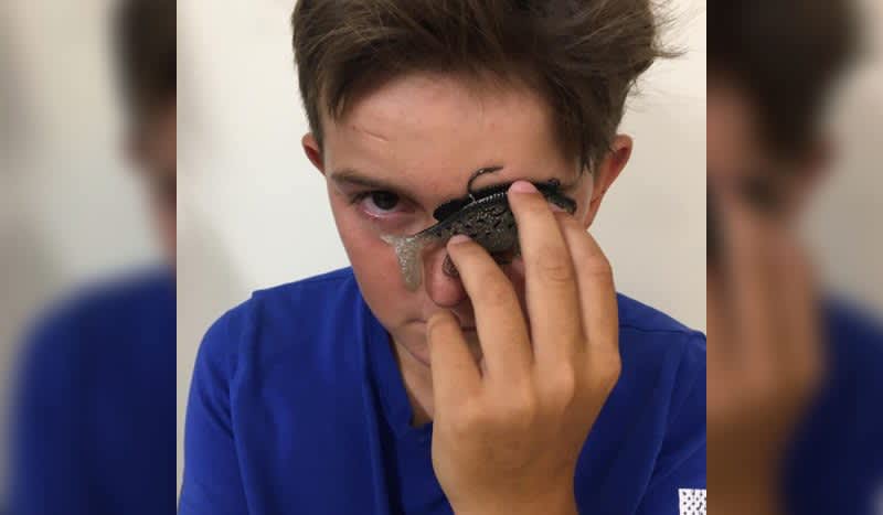 11-Year-Old Angler Catches Hook in Eyelid During Fishing Accident